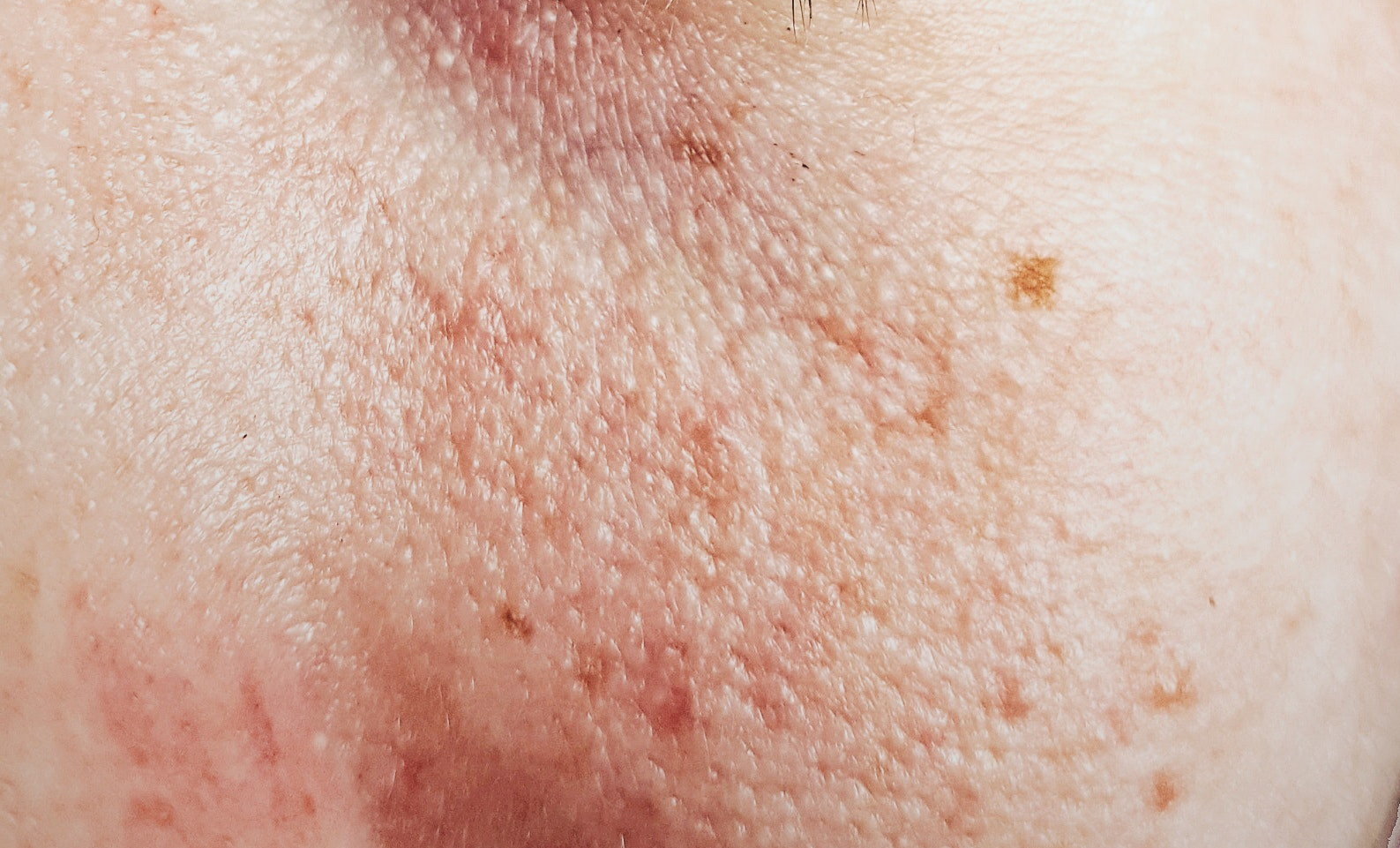 propolis tegen huidproblemen